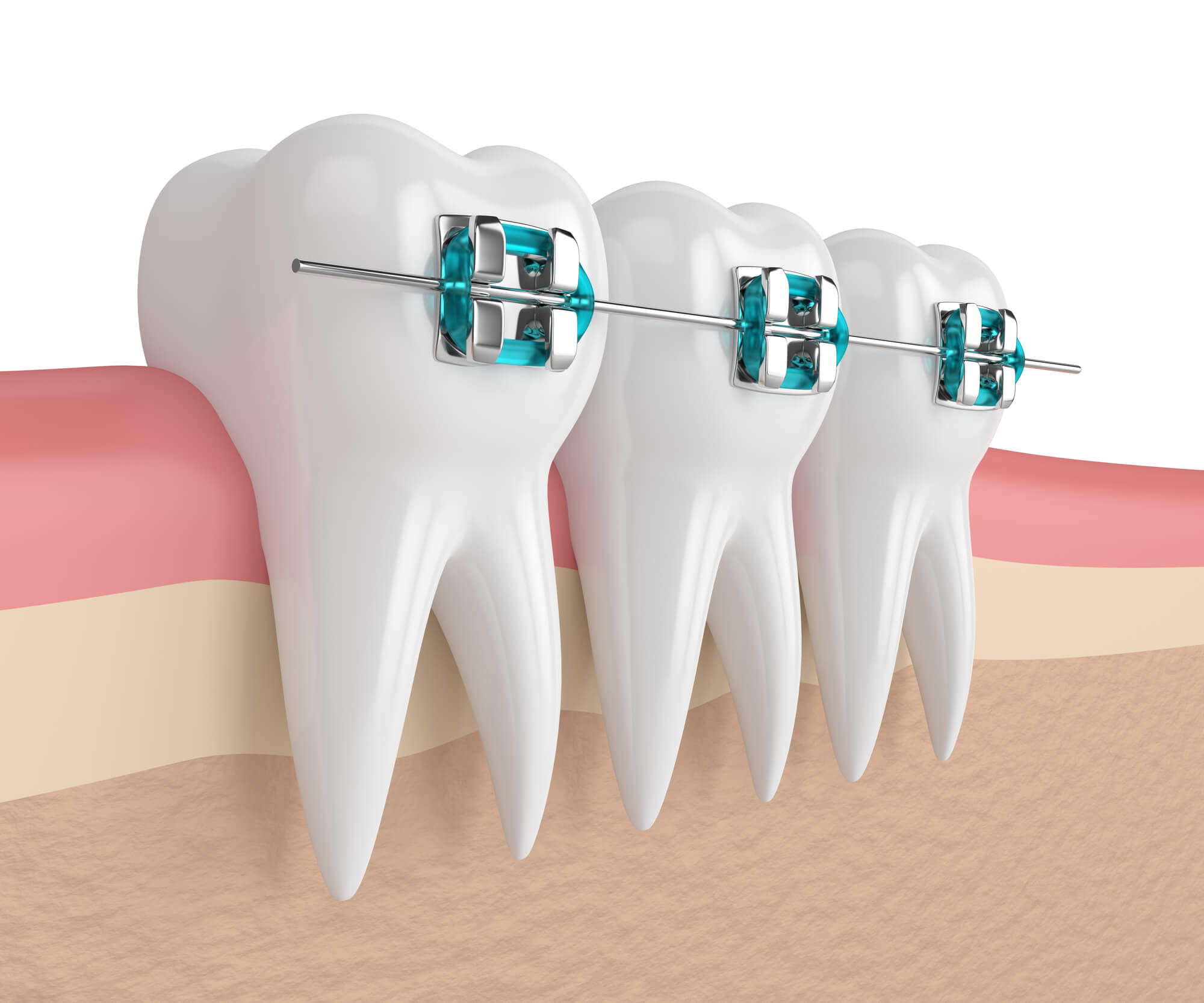 How to Deal With Ulcers Caused by Braces TLC Dental